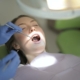 Zahnversiegelung